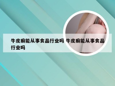 牛皮癣能从事食品行业吗 牛皮癣能从事食品行业吗