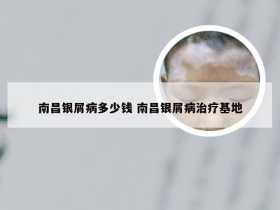 南昌银屑病多少钱 南昌银屑病治疗基地