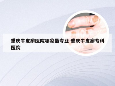 重庆牛皮癣医院哪家最专业 重庆牛皮癣专科医院