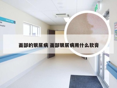面部的银屑病 面部银屑病用什么软膏
