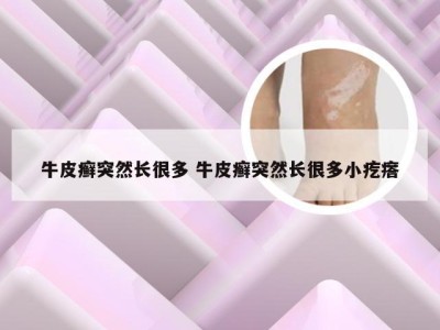 牛皮癣突然长很多 牛皮癣突然长很多小疙瘩