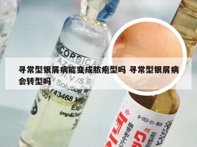寻常型银屑病能变成脓疱型吗 寻常型银屑病会转型吗