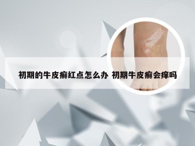 初期的牛皮癣红点怎么办 初期牛皮癣会痒吗