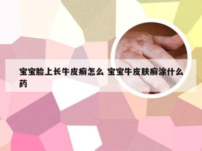 宝宝脸上长牛皮癣怎么 宝宝牛皮肤癣涂什么药