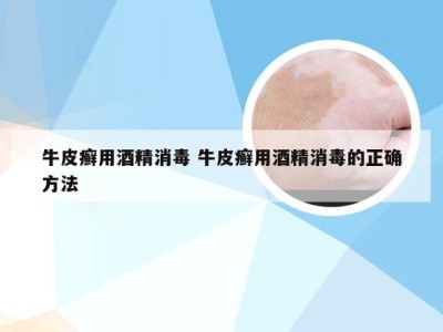 牛皮癣用酒精消毒 牛皮癣用酒精消毒的正确方法