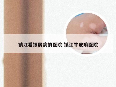 镇江看银屑病的医院 镇江牛皮癣医院