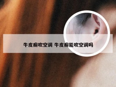 牛皮癣吹空调 牛皮癣能吹空调吗