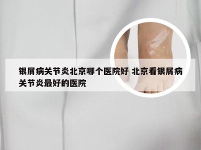 银屑病关节炎北京哪个医院好 北京看银屑病关节炎最好的医院