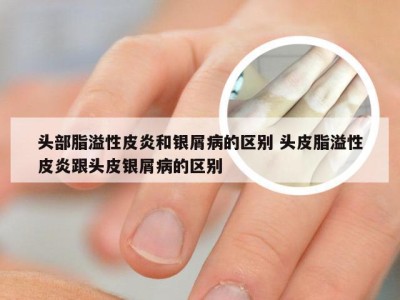 头部脂溢性皮炎和银屑病的区别 头皮脂溢性皮炎跟头皮银屑病的区别