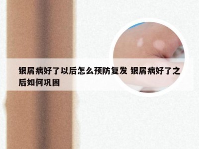 银屑病好了以后怎么预防复发 银屑病好了之后如何巩固