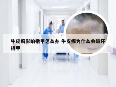 牛皮癣影响指甲怎么办 牛皮癣为什么会破坏指甲