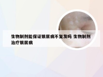 生物制剂能保证银屑病不复发吗 生物制剂 治疗银屑病
