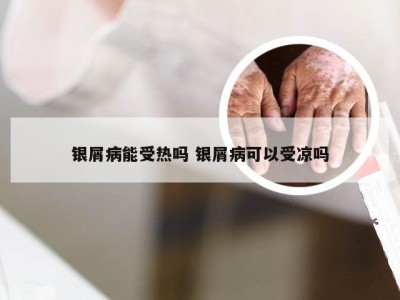 银屑病能受热吗 银屑病可以受凉吗