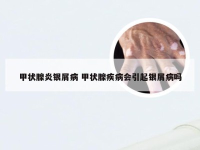 甲状腺炎银屑病 甲状腺疾病会引起银屑病吗