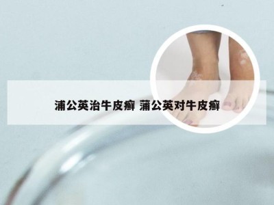 浦公英治牛皮癣 蒲公英对牛皮癣