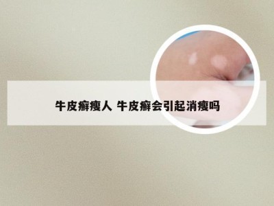 牛皮癣瘦人 牛皮癣会引起消瘦吗