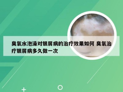 臭氧水泡澡对银屑病的治疗效果如何 臭氧治疗银屑病多久做一次
