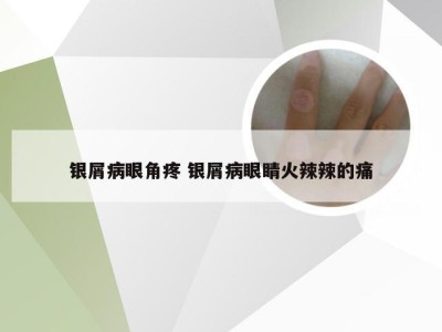 银屑病眼角疼 银屑病眼睛火辣辣的痛