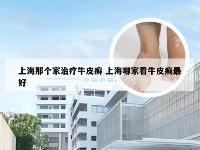 上海那个家治疗牛皮癣 上海哪家看牛皮癣最好