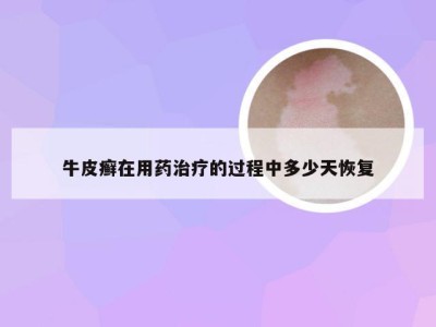 牛皮癣在用药治疗的过程中多少天恢复