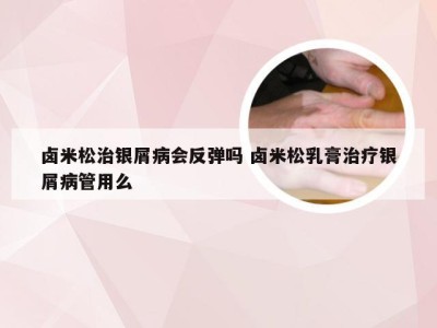 卤米松治银屑病会反弹吗 卤米松乳膏治疗银屑病管用么