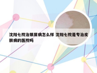 沈阳七院治银屑病怎么样 沈阳七院是专治皮肤病的医院吗