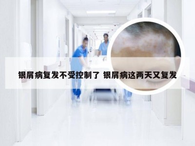 银屑病复发不受控制了 银屑病这两天又复发
