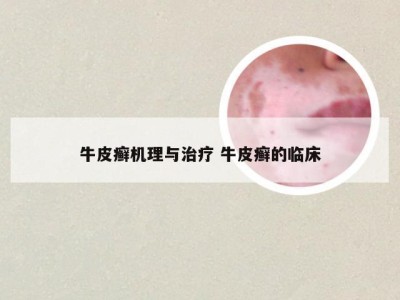 牛皮癣机理与治疗 牛皮癣的临床