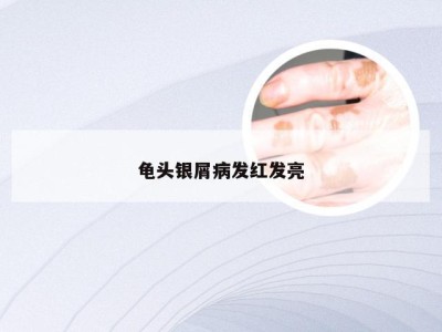 龟头银屑病发红发亮