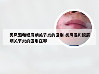 类风湿和银屑病关节炎的区别 类风湿和银屑病关节炎的区别在哪