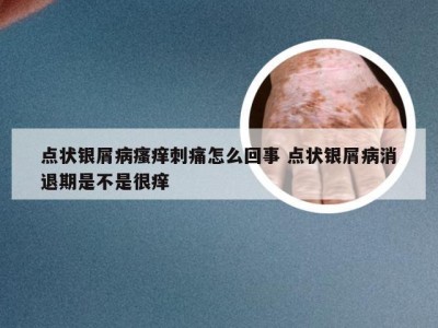 点状银屑病瘙痒刺痛怎么回事 点状银屑病消退期是不是很痒