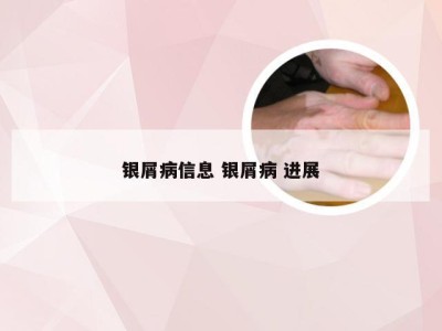 银屑病信息 银屑病 进展