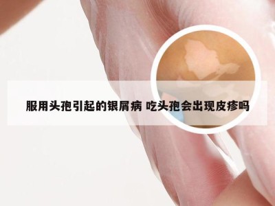服用头孢引起的银屑病 吃头孢会出现皮疹吗