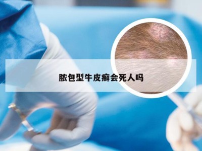 脓包型牛皮癣会死人吗