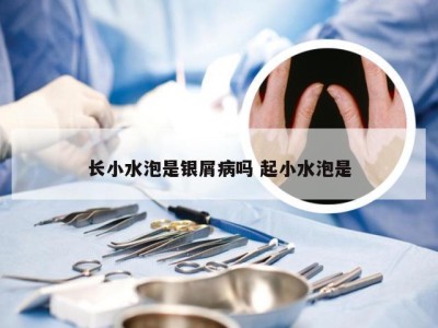 长小水泡是银屑病吗 起小水泡是
