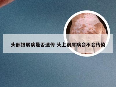 头部银屑病是否遗传 头上银屑病会不会传染