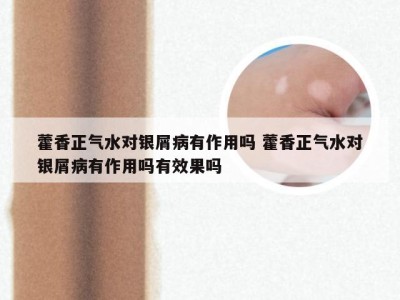 藿香正气水对银屑病有作用吗 藿香正气水对银屑病有作用吗有效果吗