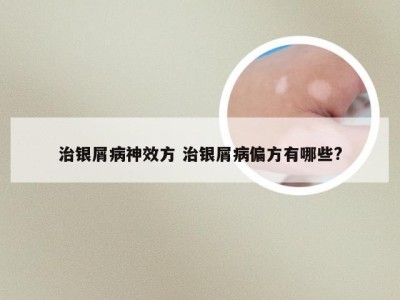 治银屑病神效方 治银屑病偏方有哪些?