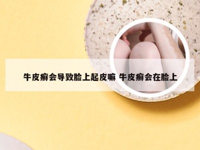 牛皮癣会导致脸上起皮嘛 牛皮癣会在脸上