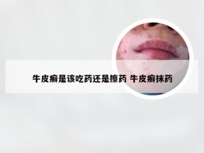 牛皮癣是该吃药还是擦药 牛皮癣抹药