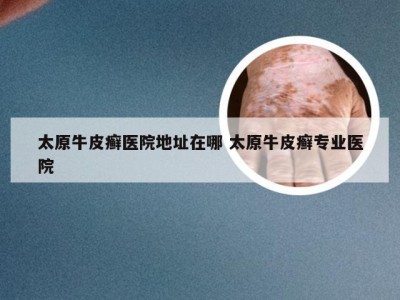 太原牛皮癣医院地址在哪 太原牛皮癣专业医院