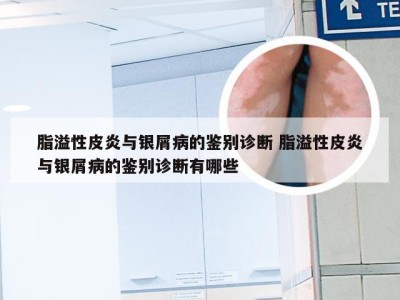 脂溢性皮炎与银屑病的鉴别诊断 脂溢性皮炎与银屑病的鉴别诊断有哪些
