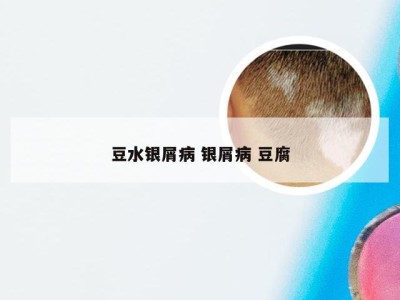 豆水银屑病 银屑病 豆腐