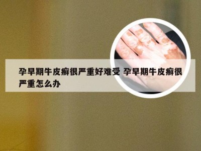 孕早期牛皮癣很严重好难受 孕早期牛皮癣很严重怎么办