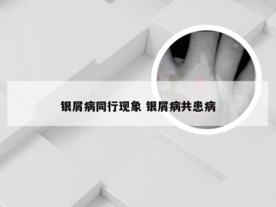 银屑病同行现象 银屑病共患病