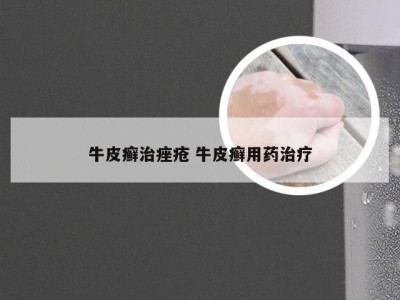 牛皮癣治痤疮 牛皮癣用药治疗