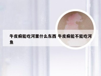 牛皮癣能吃河里什么东西 牛皮癣能不能吃河鱼