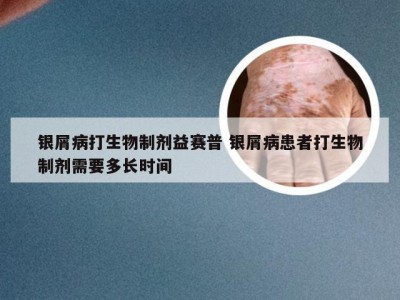 银屑病打生物制剂益赛普 银屑病患者打生物制剂需要多长时间