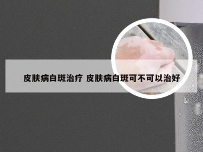 皮肤病白斑治疗 皮肤病白斑可不可以治好