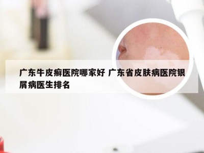 广东牛皮癣医院哪家好 广东省皮肤病医院银屑病医生排名
